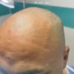 کاشت مو دائمی پر تراکم در کلینیک اندیا سعادت اباد تهران