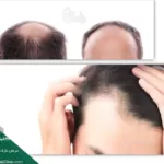 درمان نازک شدن موها - علت نازک شدن مو