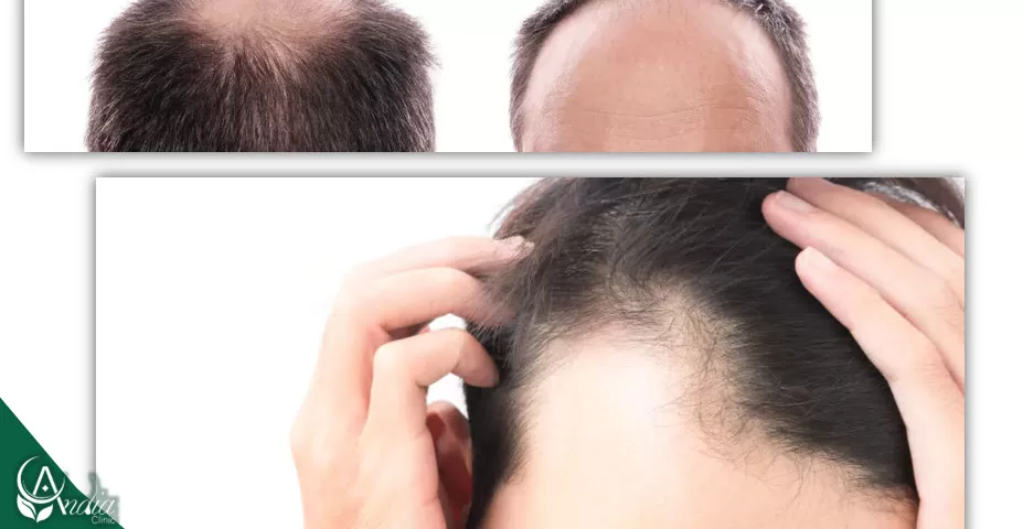 درمان نازک شدن موها - علت نازک شدن مو