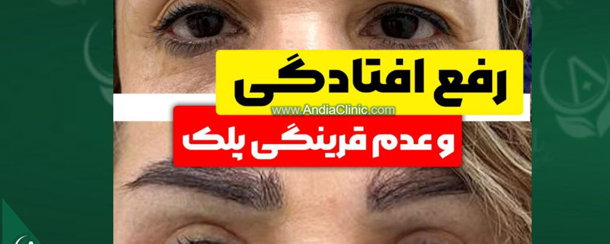 عمل رفع افتادگی و عدم قرینگی پلک با روش جراحی پتوز و تقویت عضله بالابرنده