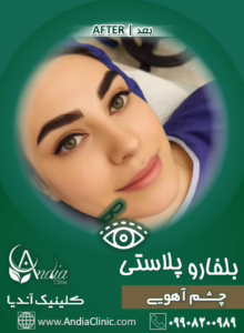 بعد از عمل چشم آهویی - عکس بعد از عمل چشم آهویی
