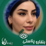 بعد از عمل چشم گربه ای
