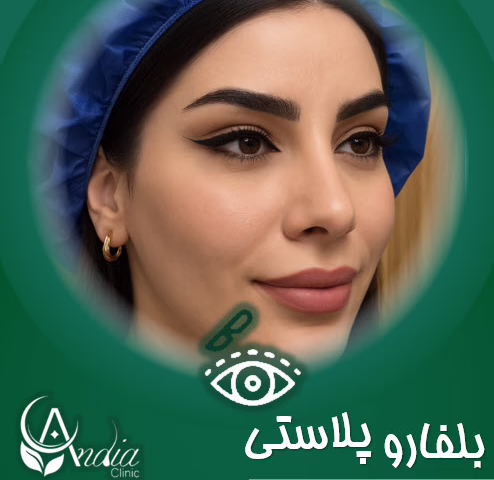 بعد از عمل چشم گربه ای