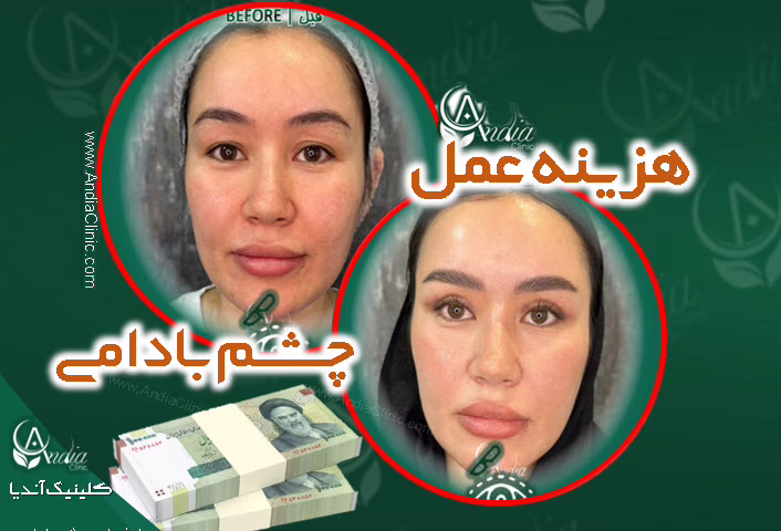 هزینه عمل چشم بادامی