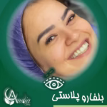 عمل زیبایی بلفاروپلاستی طبیعی