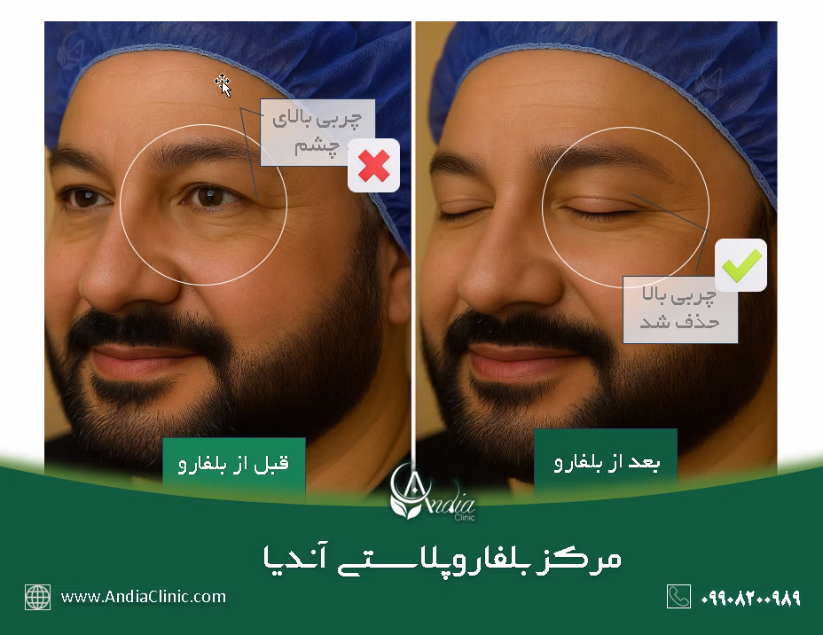 قبل و بعد از بلفاروپلاستی
