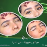 عمل اپیکانتوپلاستی و بلفاروپلاستی