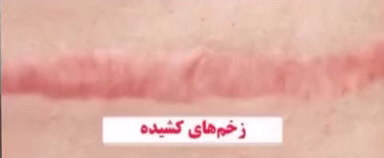 زخم های کشیده